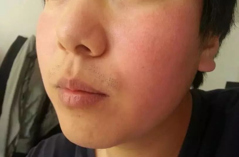 紅血絲的種類有哪些？