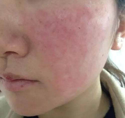 紅血絲的種類有哪些？