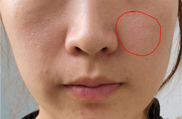 毛孔粗大 毛孔粗大如何預防?毛孔粗大預防措施