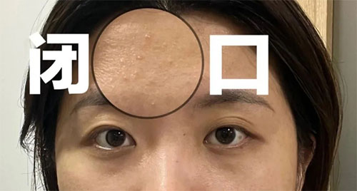 閉口粉刺形成的原因有哪些？