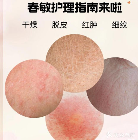 為什么春天容易過敏？春天容易過敏的原因！